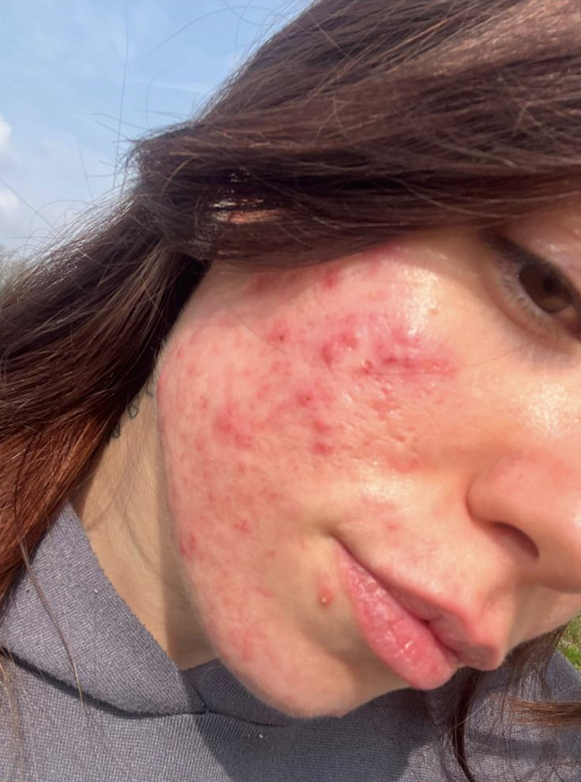 Eleonora before, inflammatory acne visible on the cheek